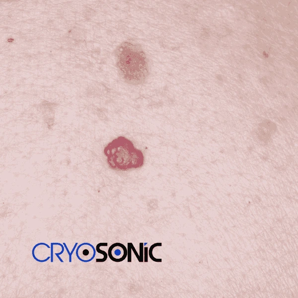 Looking for pain free cherry angioma removal treatment Canterbury? Call our team today! Canterbury