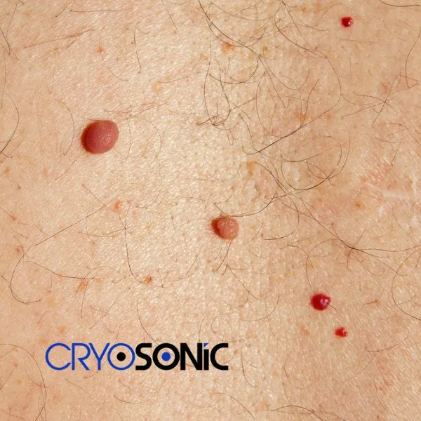 get cherry angioma removal treatment today! Canterbury