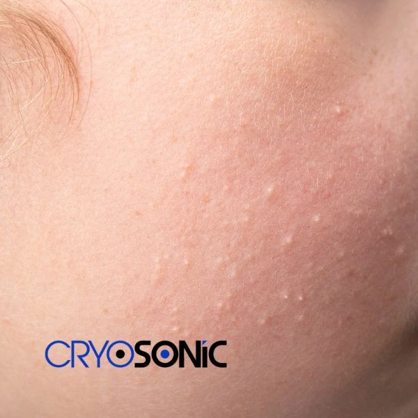 Are you looking for milia removal treatment? Contact our team today Canterbury
