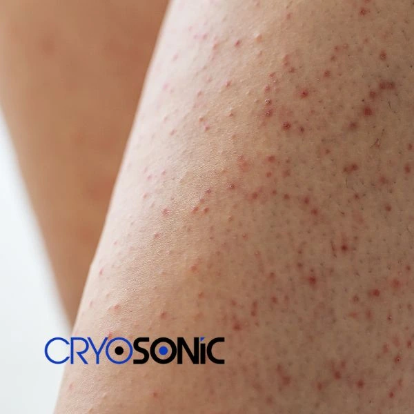 Looking for Seborrhoeic Keratosis removal Canterbury treatment? Call our consultants today in Canterbury