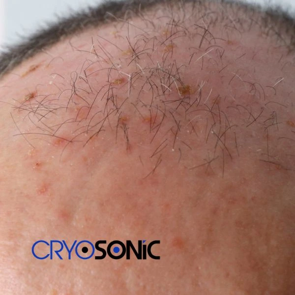 Access Seborrhoeic Keratosis removal from the comfort of your own home! Call us today in Canterbury
