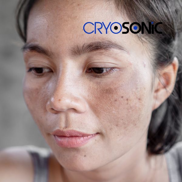 Ready to start age spots removal? Contact our team today in Canterbury