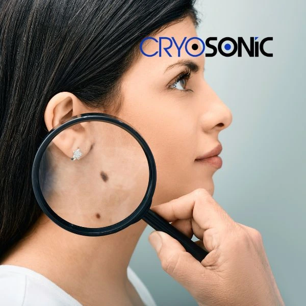 Do you want to learn more about benign moles removal treatment? Call our team today Canterbury