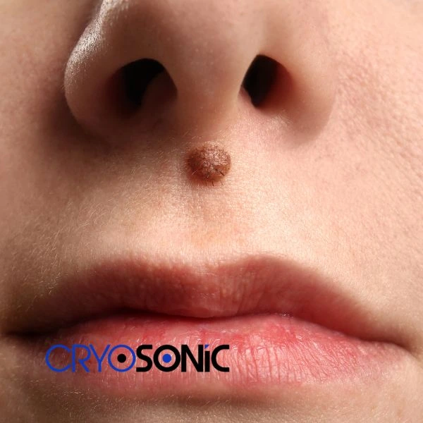 Start your benign moles removal treatment today Canterbury