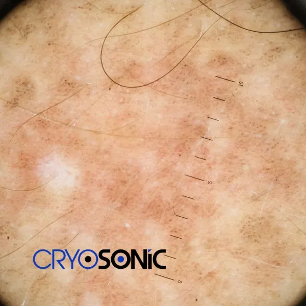 Speak to our team today about sun damaged skin treatment today in Canterbury
