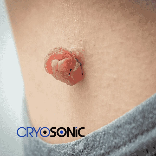 Book your skin tags removal Canterbury from comfort of your own home! Canterbury