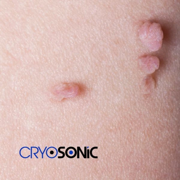 Are you looking for fast effect skin tag removal Canterbury? Book in NOW! Canterbury