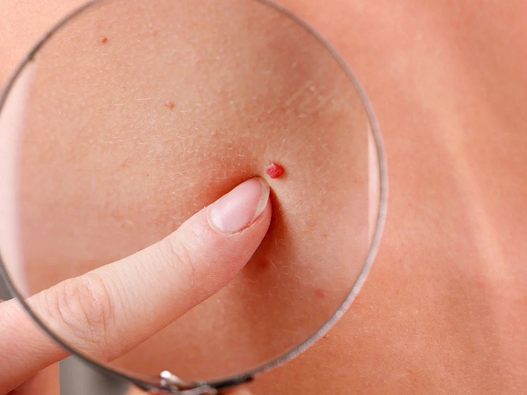 Cherry Angiomas on skin showing vascular structure and Cryosonic CryoPen treatment for effective lesion removal Canterbury