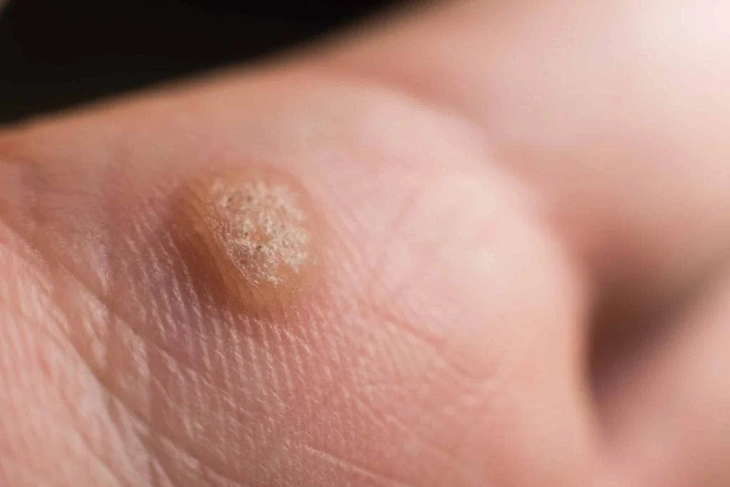 CryoPen treatment for Common Warts showing precise freezing of viral skin lesions for safe and effective removal Canterbury
