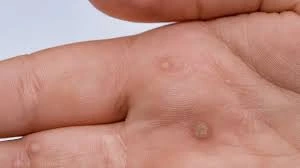CryoPen treatment results showing smooth skin after Common Warts Canterbury removal with reduced risk of recurrence Canterbury