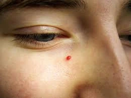 Benefits of Cryosonic CryoPen for Cherry Angiomas Canterbury , showing precise, safe, and effective removal of vascular skin lesions Canterbury