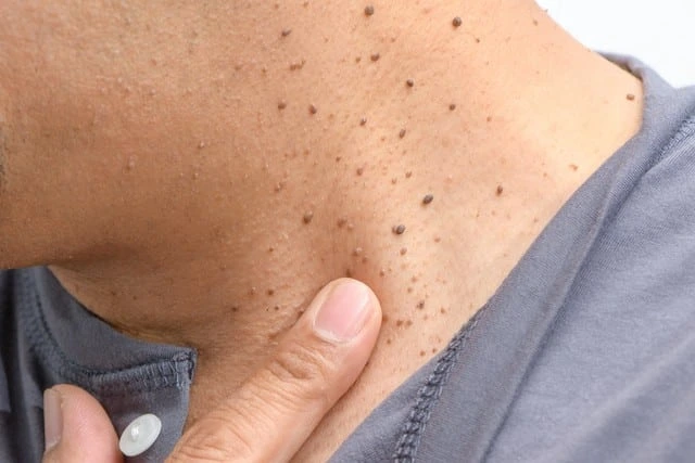 Benefits of Cryosonic CryoPen Canterbury for darker skin, highlighting safe, fast, and precise removal of Dermatosis Papulosa Nigra Canterbury