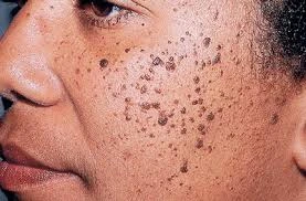 Cryosonic CryoPen treatment Canterbury showing Dermatosis Papulosa Nigra on darker skin Canterbury
