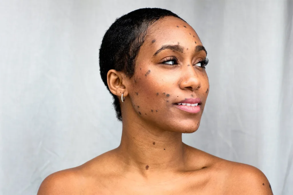 Dermatosis Papulosa Nigra on darker skin treated with Cryosonic CryoPen, showing genetic factors and effective removal Canterbury
