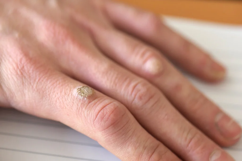 Patient considering removal of Common Warts Canterbury for cosmetic improvement, comfort, and hygiene with CryoPen treatment Canterbury