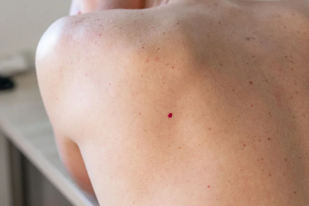 Close-up of Cherry Angiomas Canterbury on skin, showing small red vascular lesions and their typical appearance Canterbury