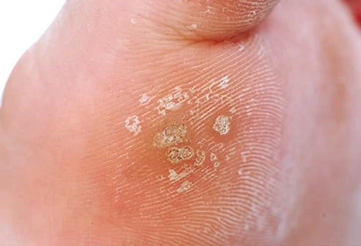 Close-up of Common Warts Canterbury on skin, showing small rough viral lesions typically caused by HPV infection Canterbury