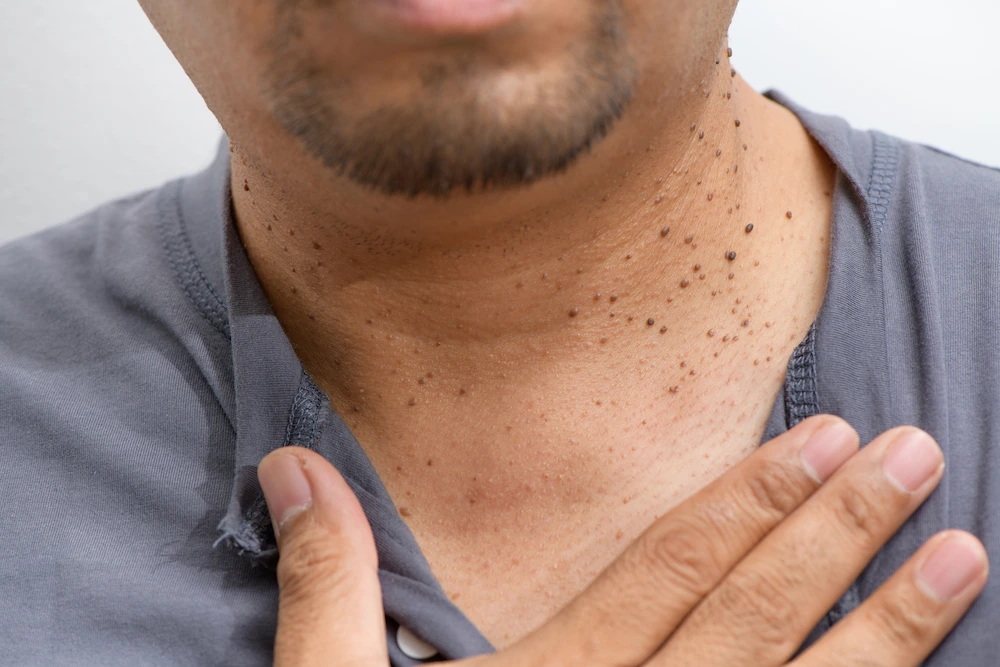 Dermatosis Papulosa Nigra Canterbury on darker skin, showing genetic factors Canterbury