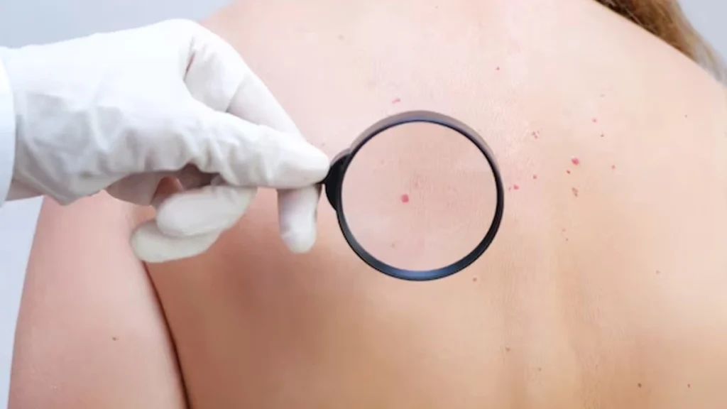Person considering Cherry Angiomas Canterbury removal, highlighting cosmetic and comfort reasons for treatment with CryoPen Canterbury